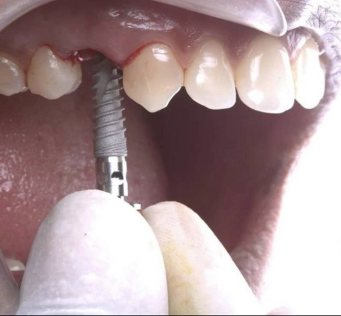 Full Mouth Dental Implants in Koparkhairane for a Natural Smile
