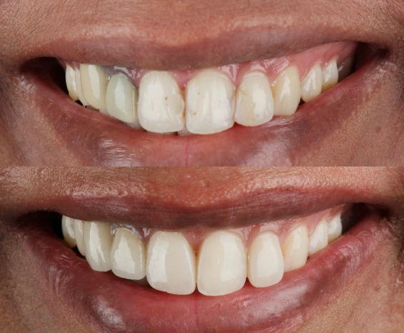 Ceramic dental crowns