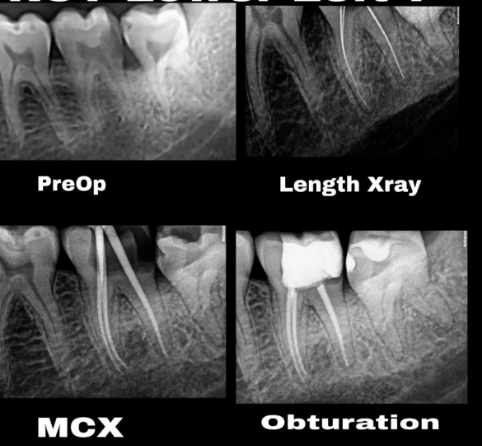 Root Canal Treatment in Koparkhairane