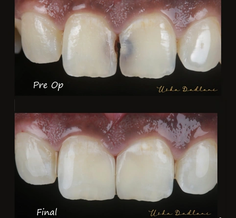 Cosmetic Dentistry in Koparkhairane for a Confident Smile