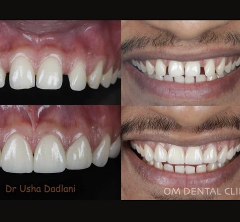 Feeling anxious and self-conscious about your smile due to damaged teeth?